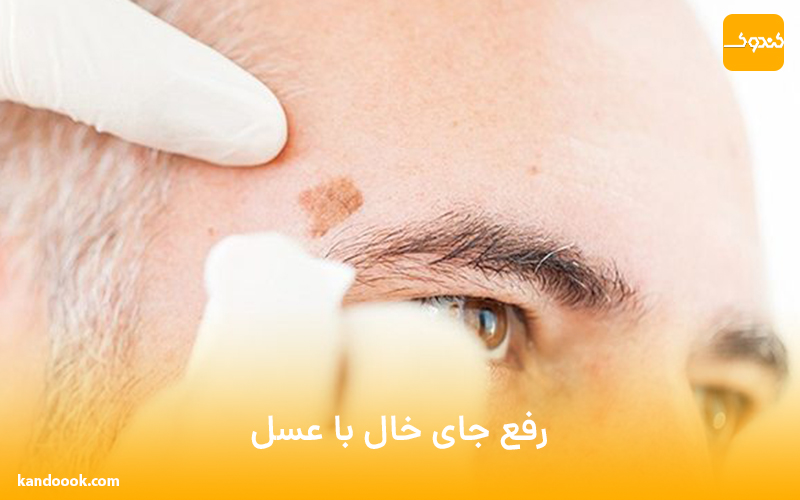 رفع جای خال با عسل !