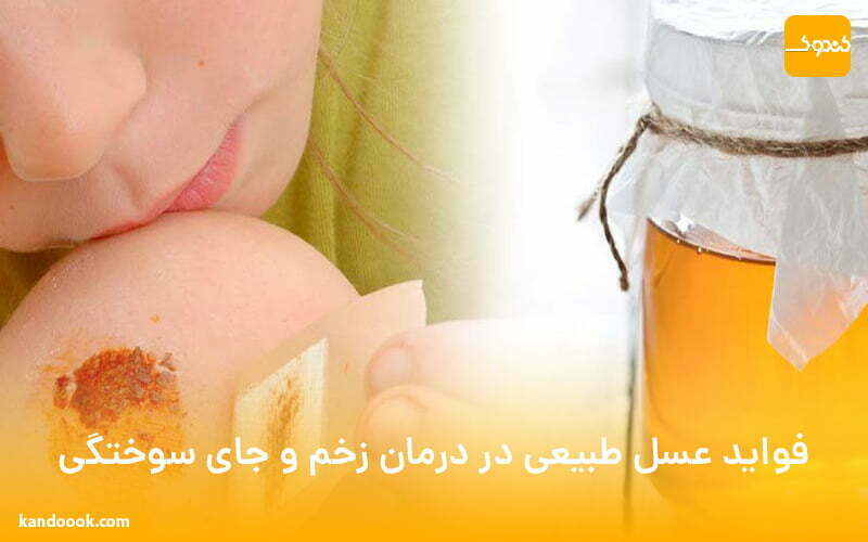 فواید عسل طبیعی در درمان زخم و جای سوختگی