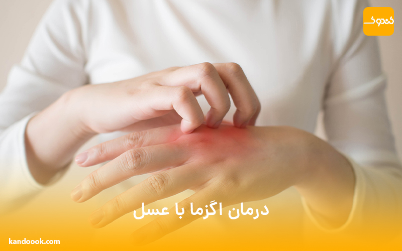 درمان اگزما با عسل
