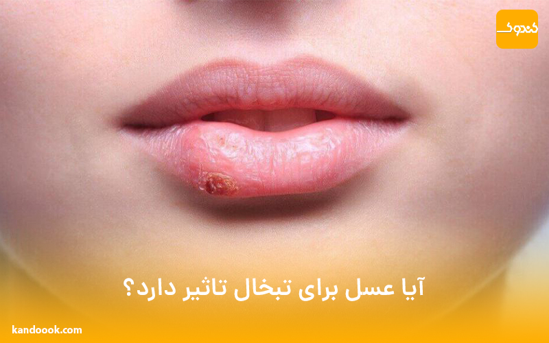 آیا عسل برای تبخال تاثیر دارد؟