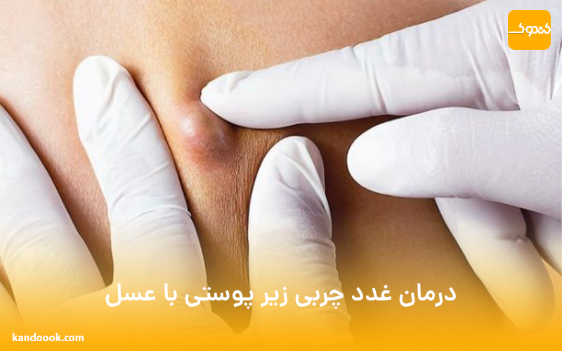 درمان غدد چربی زیر پوستی با عسل