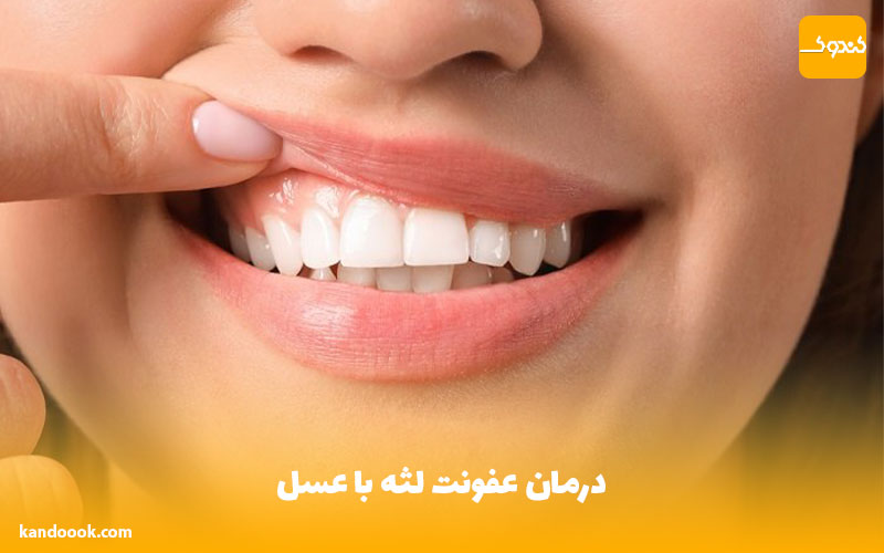 درمان عفونت لثه با عسل