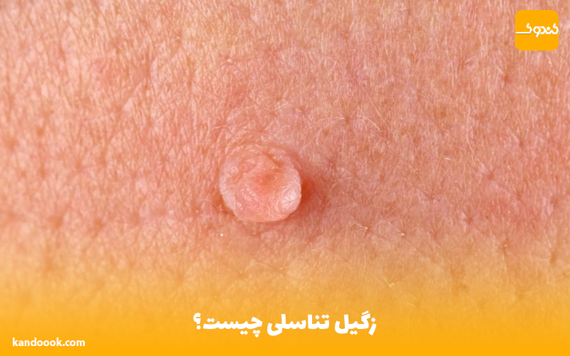 زگیل تناسلی چیست؟