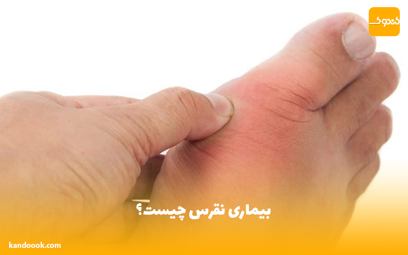 بیماری نقرس چیست؟