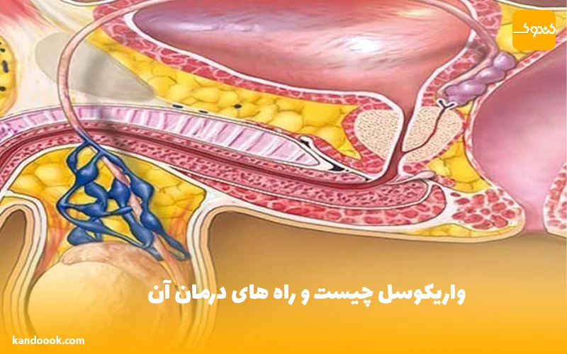 واریکوسل چیست و راه های درمان آن