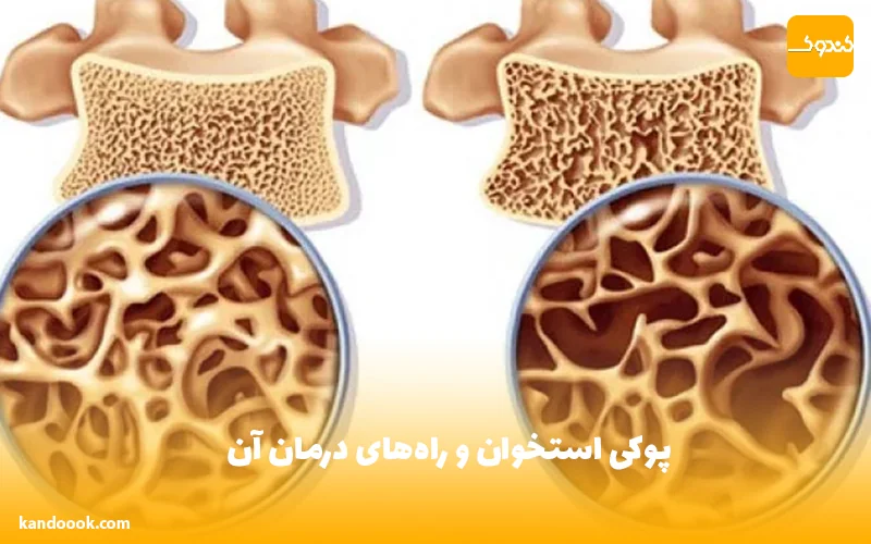 پوکی استخوان و راه‌های درمان آن