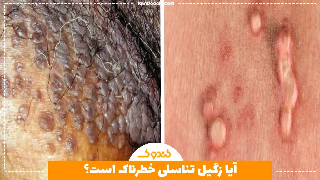 آیا زگیل تناسلی خطرناک است؟