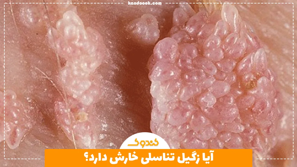 آیا زگیل تناسلی خارش دارد؟