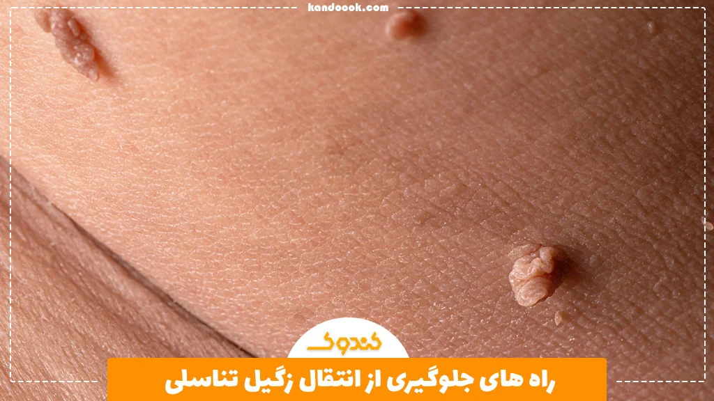راه های جلوگیری از انتقال زگیل تناسلی