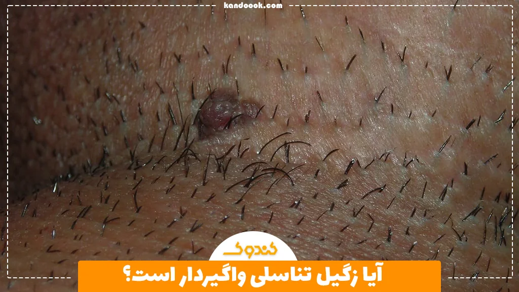 آیا زگیل تناسلی واگیردار است؟