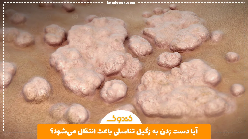 آیا دست زدن به زگیل تناسلی باعث انتقال می‌شود؟