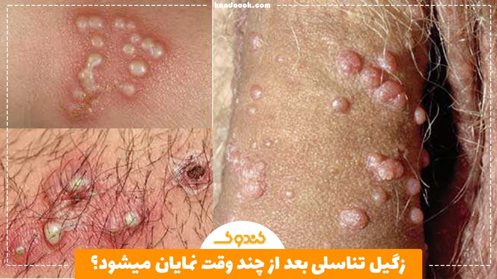 زگیل تناسلی بعد از چند وقت نمایان میشود؟