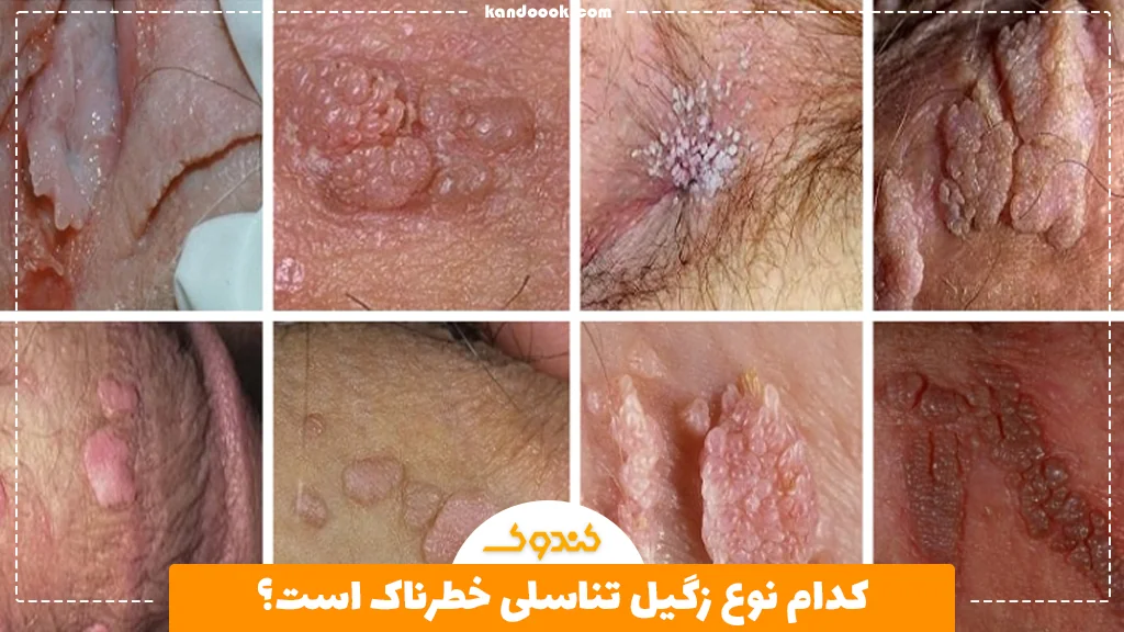 کدام نوع زگیل تناسلی خطرناک است؟