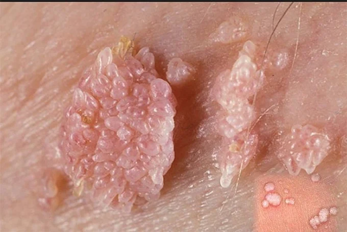 مدت زمان انتقال زگیل تناسلی؛ ویروس HPV چقدر سریع منتقل می‌شود؟