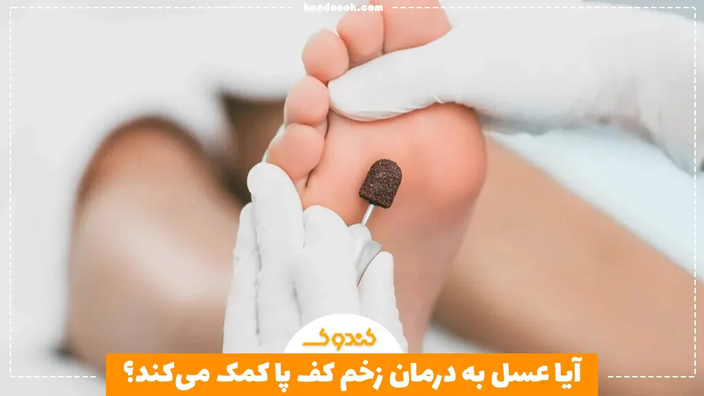 آیا عسل به درمان زخم کف پا کمک می‌کند؟