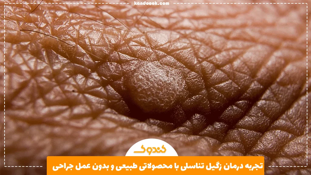 تجربه درمان زگیل تناسلی با محصولاتی طبیعی و بدون عمل جراحی