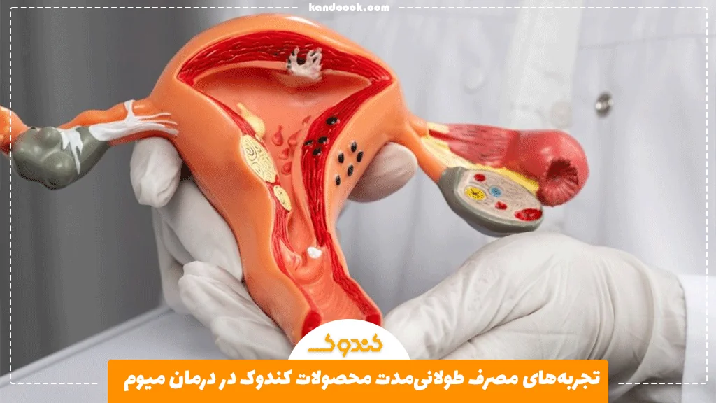 تجربه‌های مصرف طولانی‌مدت محصولات کندوک در درمان میوم