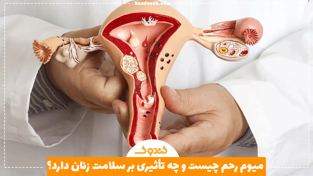 میوم رحم چیست و چه تأثیری بر سلامت زنان دارد؟